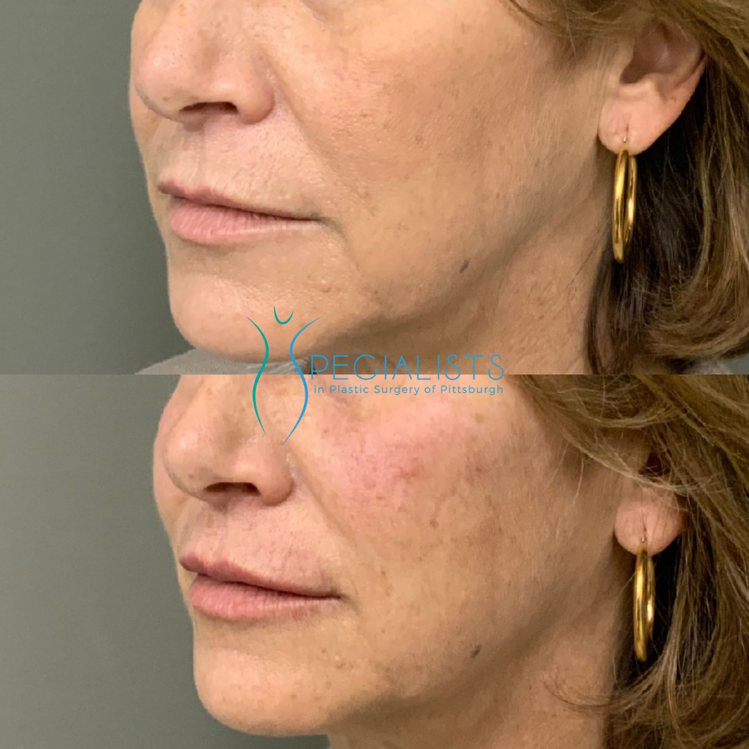 Fillers and Injectables - Before and After - 7