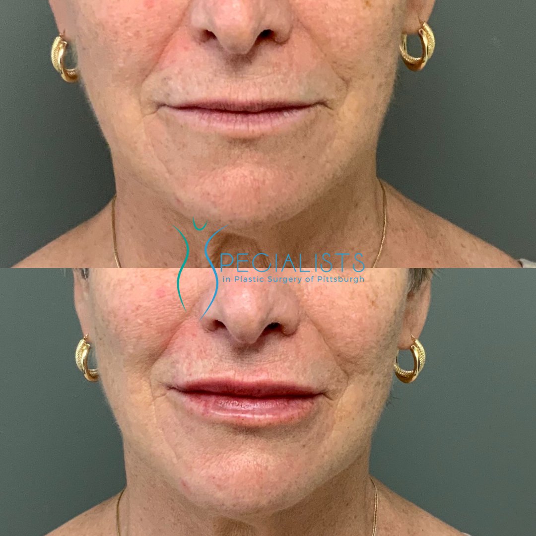 Fillers and Injectables - Before and After - 4