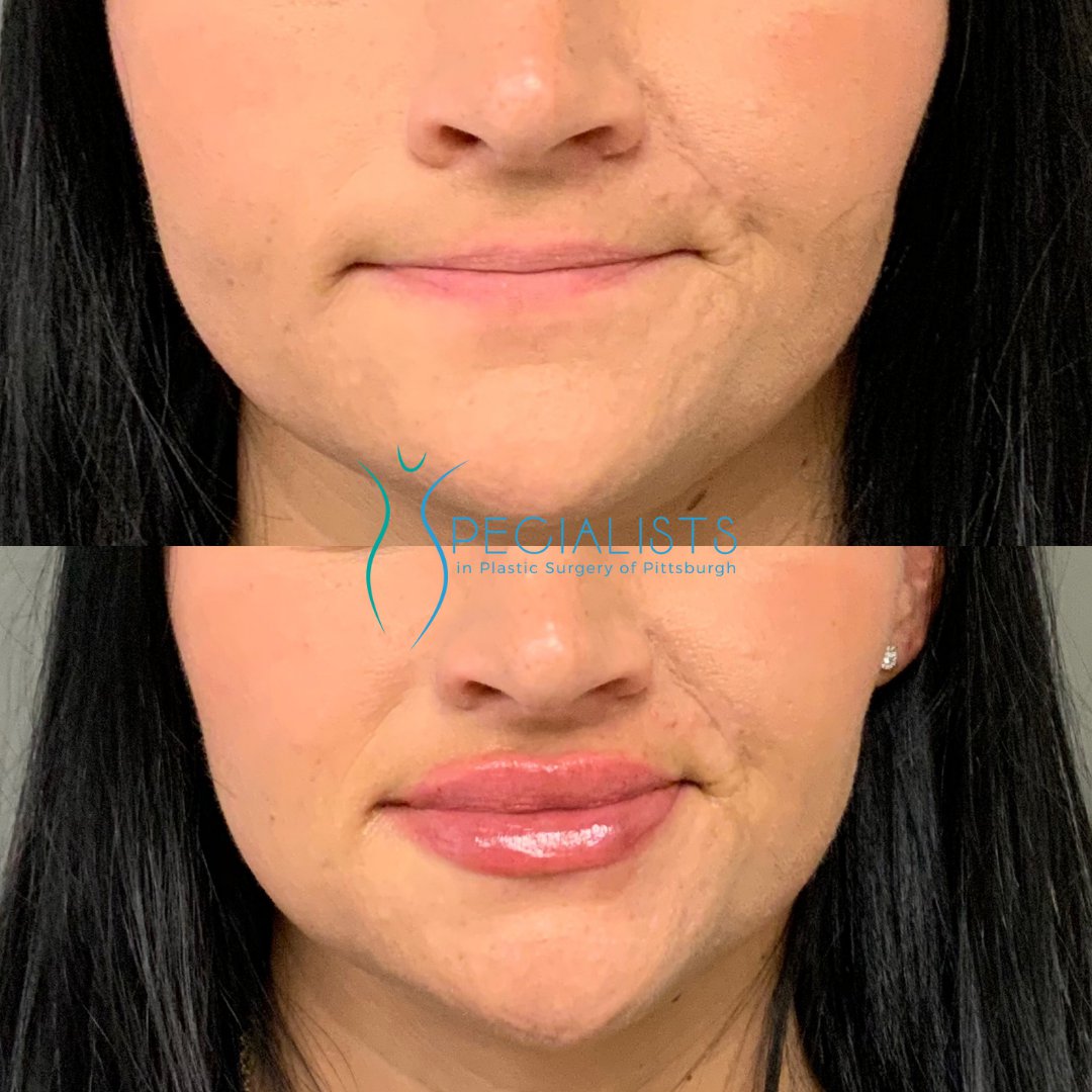 Fillers and Injectables - Before and After - 3