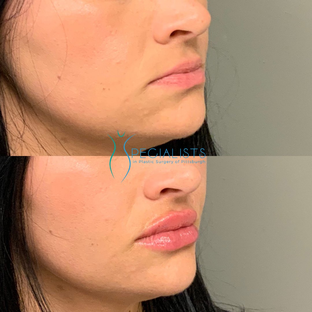 Fillers and Injectables - Before and After - 7