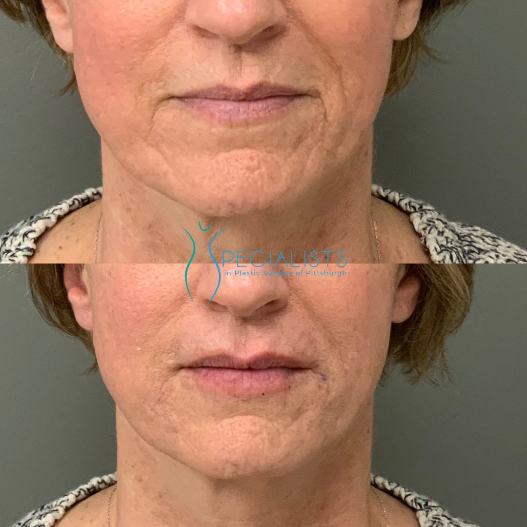 Fillers and Injectables - Before and After - 7