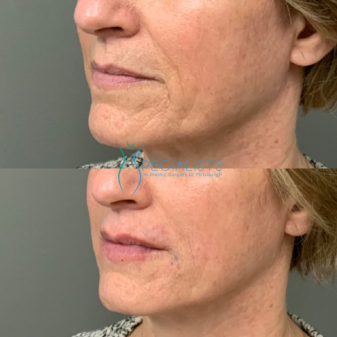 Fillers and Injectables - Before and After - 7