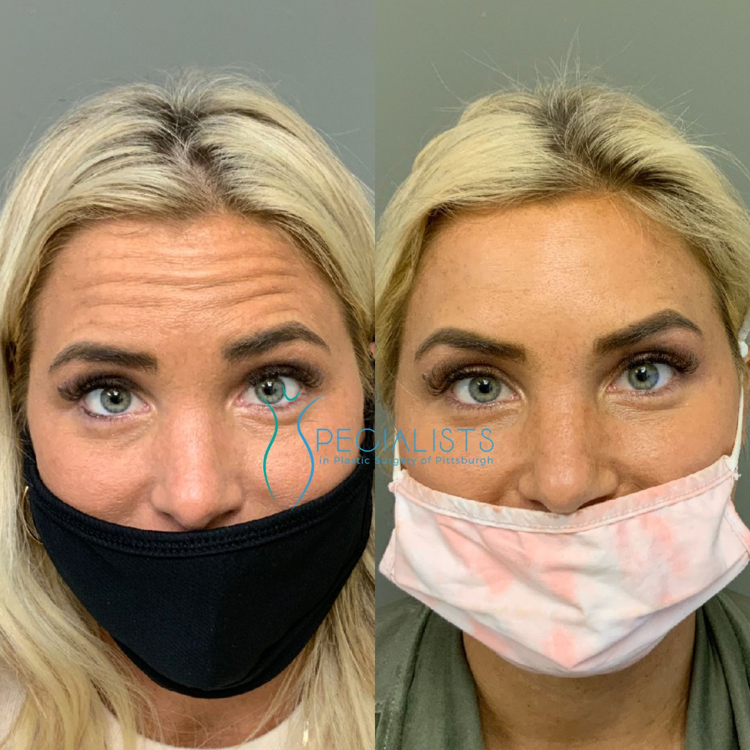 Fillers and Injectable before-after1