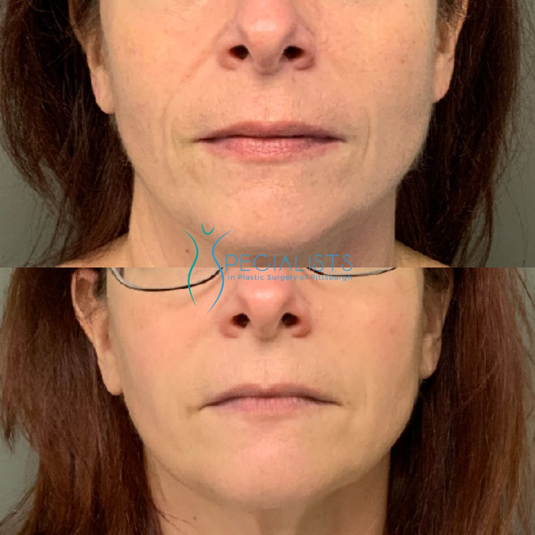 Fillers and Injectables - Before and After - 7