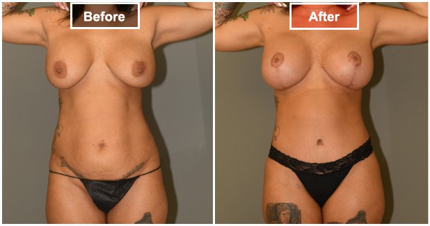 Mommy Makeover Surgery  before and after