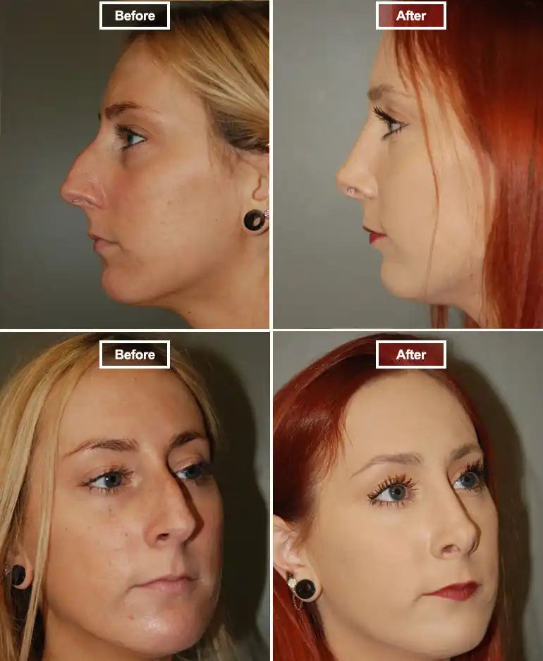 Rhinoplasty 1