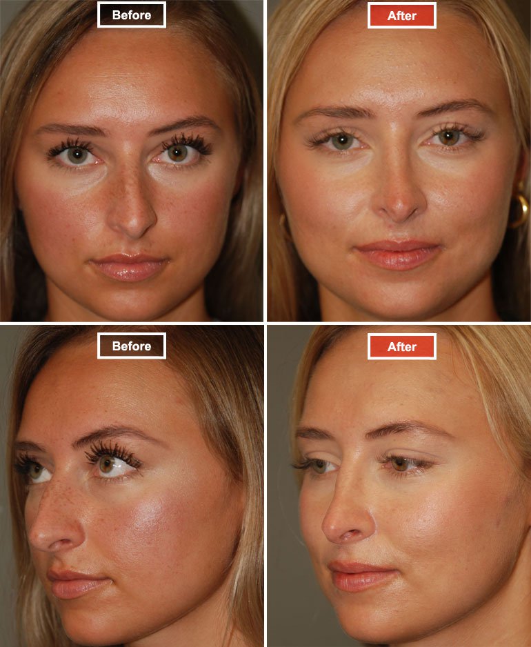 
Rhinoplasty - before and after - 2