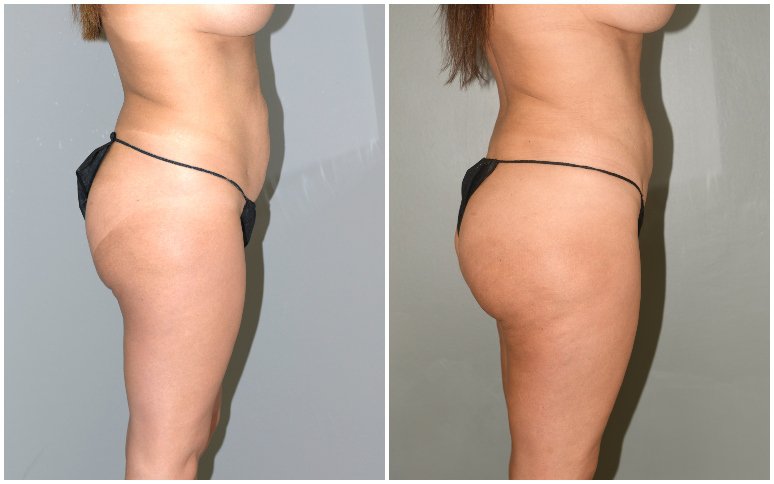 Butt Lift - Before After