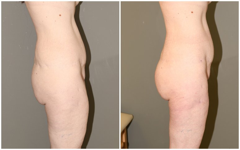 Butt Lift- Before and After -5