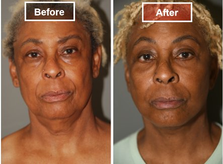 Facelift- Before and After - 13