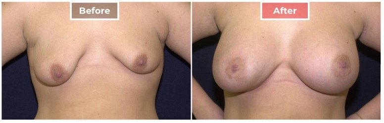 Breast Asymmetry Correction - Before and After - 4