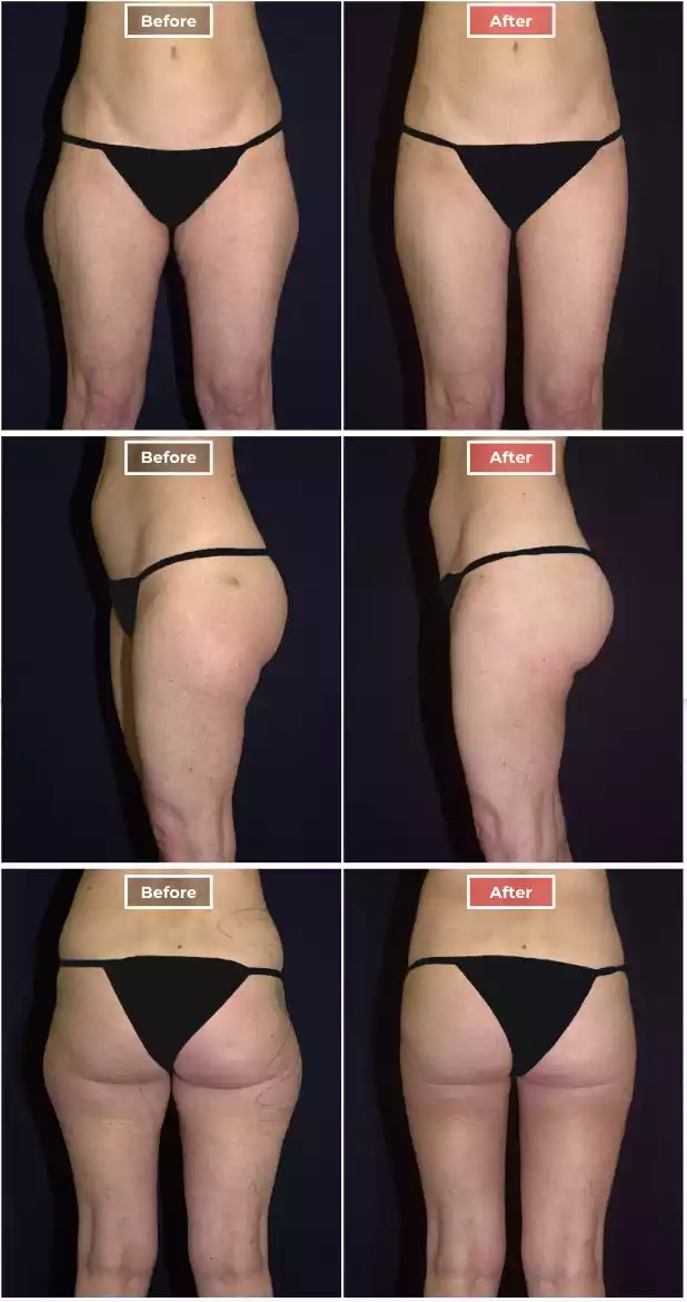 Liposuction 1