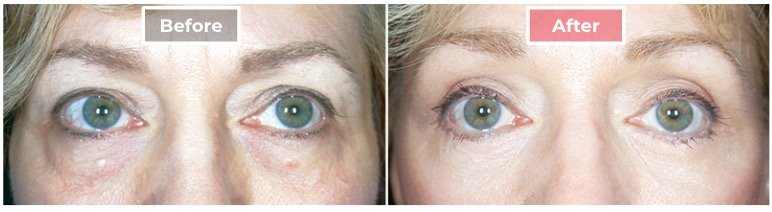 Cosmetic Eyelid Surgery before and after