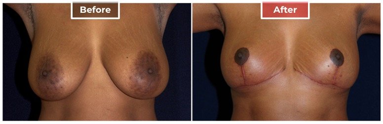 Breast Reduction - Before and After - 7