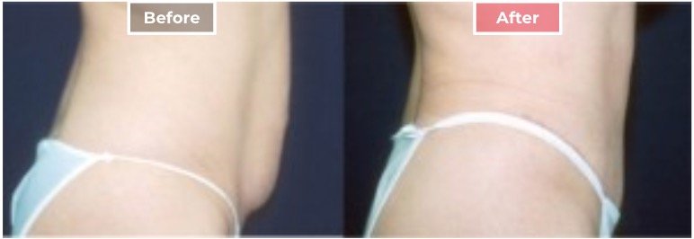 Tummy Tuck Surgery before and after - 6