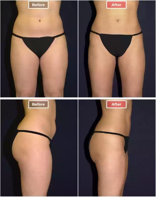 Liposuction 3