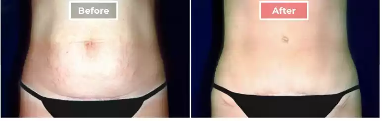 Tummy Tuck 3