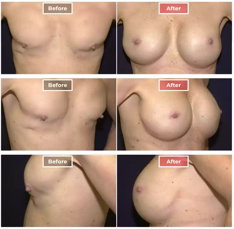 Breast Augmentation Near Me  Breast Surgery Revision - Pittsburgh, PA