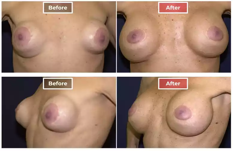 Breast Revision 2