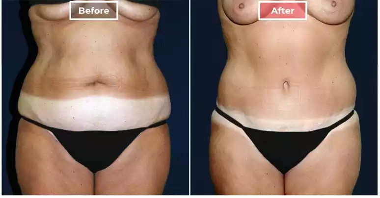 Tummy Tuck 4