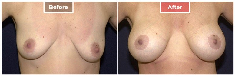 Breast Lift- Before and After - 3