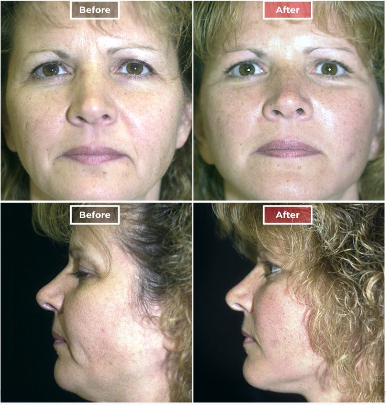 Facelift- Before and After - 2