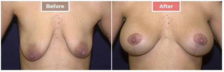 Breast Lift- Before and After - 6