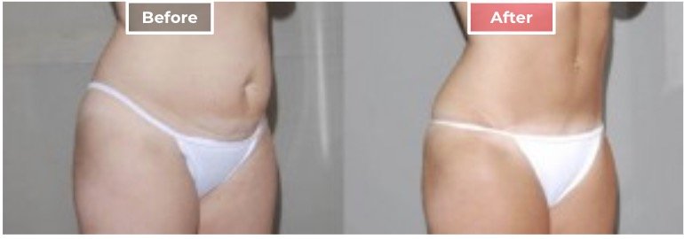 Tummy Tuck Surgery before and after - 4