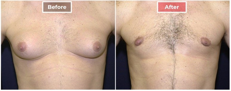 Male Breast Reduction I Gynecomastia before and after -1