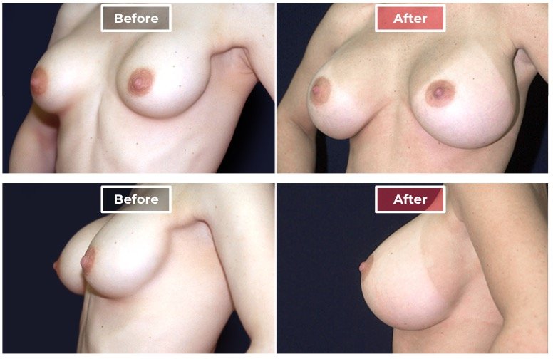 Breast Augmentation Revision - Before and After - 6