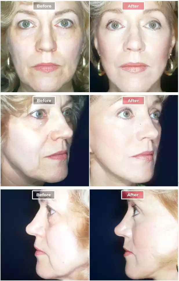 Eyelid Surgery 2