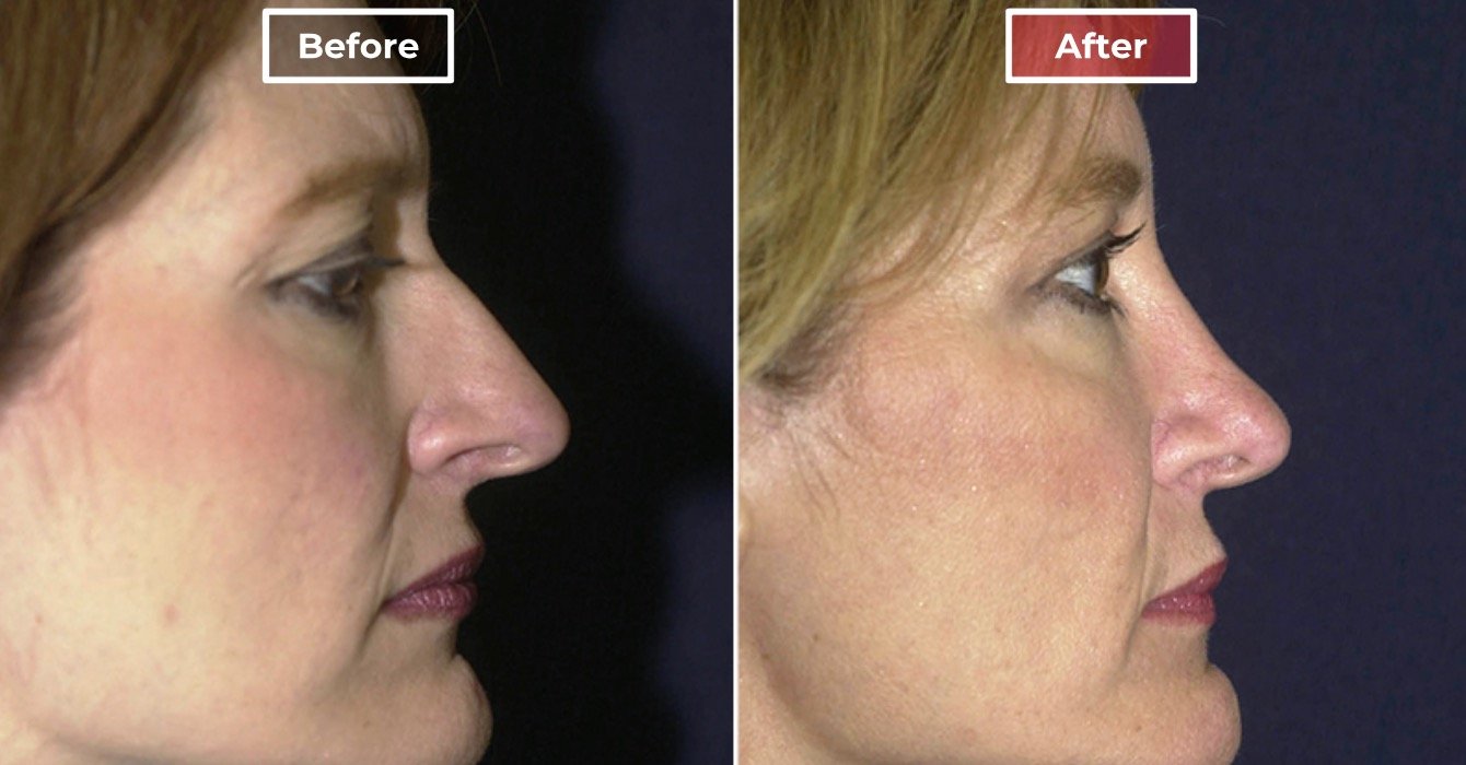 Rhinoplasty - before and after - 5