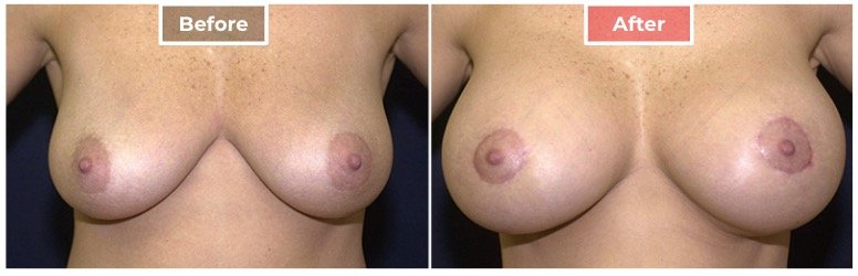 Breast Lift- Before and After - 4