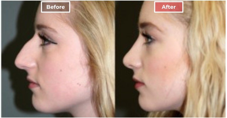 Rhinoplasty - before and after - 6