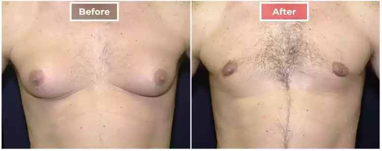 Male Breast Reduction 2