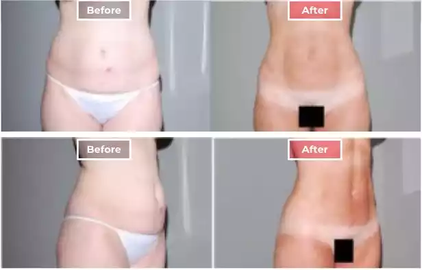 Liposuction 4