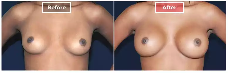 Breast Augmentation 6