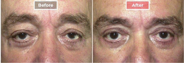 Male Eyelid Surgery before and after