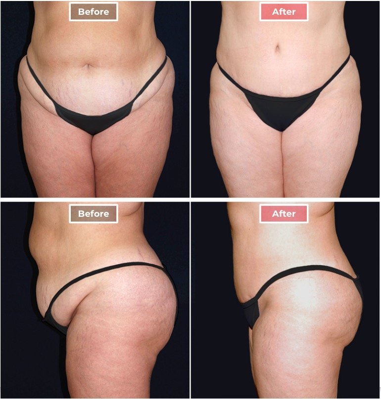 Tummy Tuck Surgery before and after