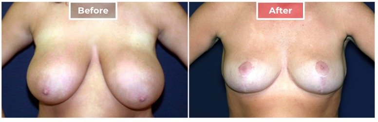 Breast Reduction - Before and After - 4