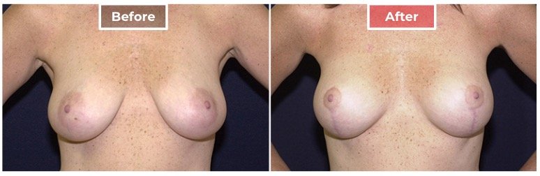 Breast Lift- Before and After - 8