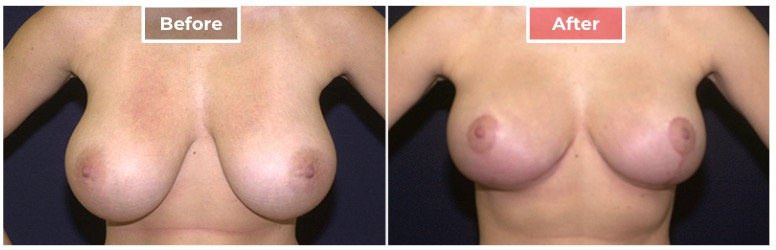 Breast Reduction - Before and After - 5