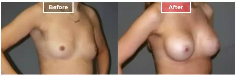 Breast Augmentation 12