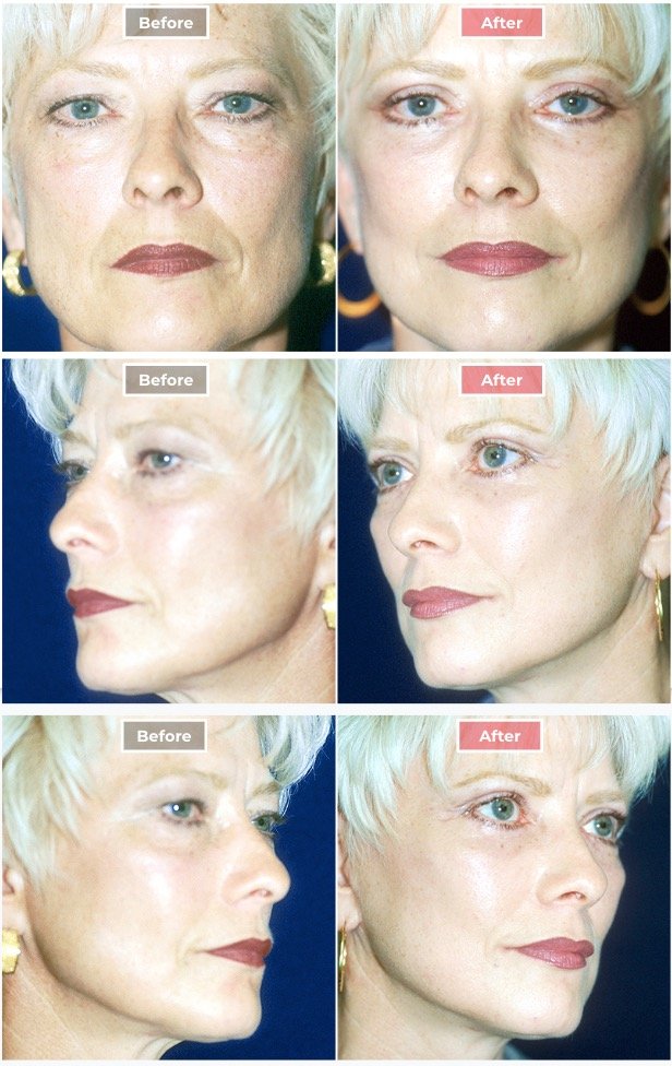 Facelift Surgery | Neck & Face Lifts  before and after -2