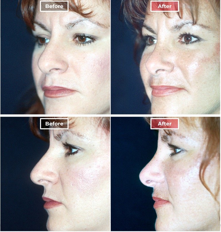 Rhinoplasty - before and after - 3