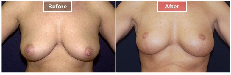 Breast Lift- Before and After - 1