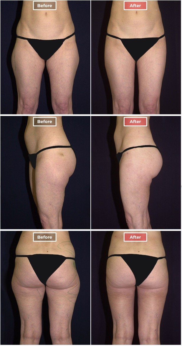 Liposuction treatment before and after
