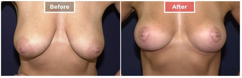 Breast Lift- Before and After - 7