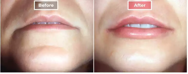 Lip Augmentation 2