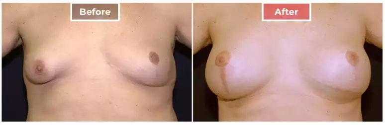 Breast Correction 2